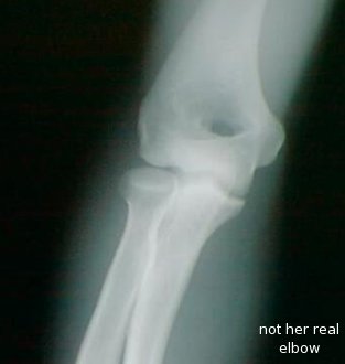 x-ray of a dislocated elbow